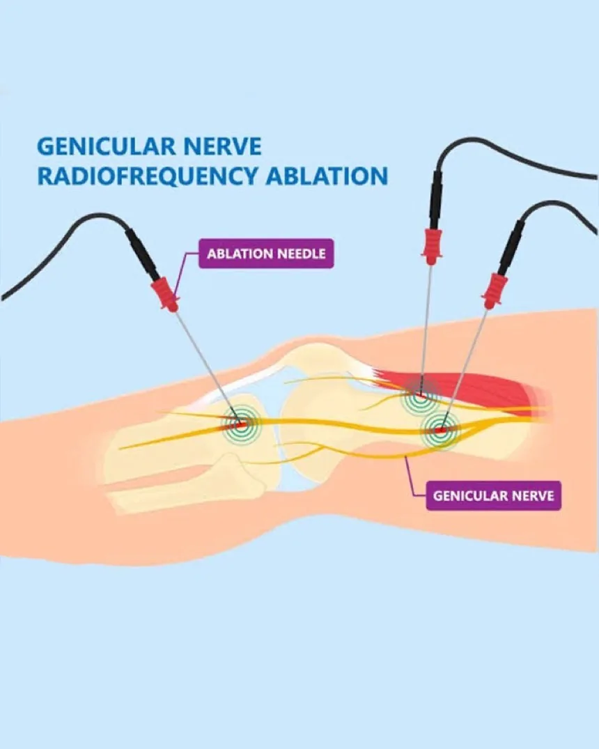 Diagram of radiofrequency ablation of the genicular nerves at the knee